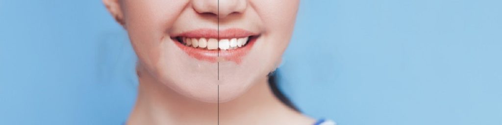 How Non-Natural Teeth Bleaching Methods Cause Gum Irritation?