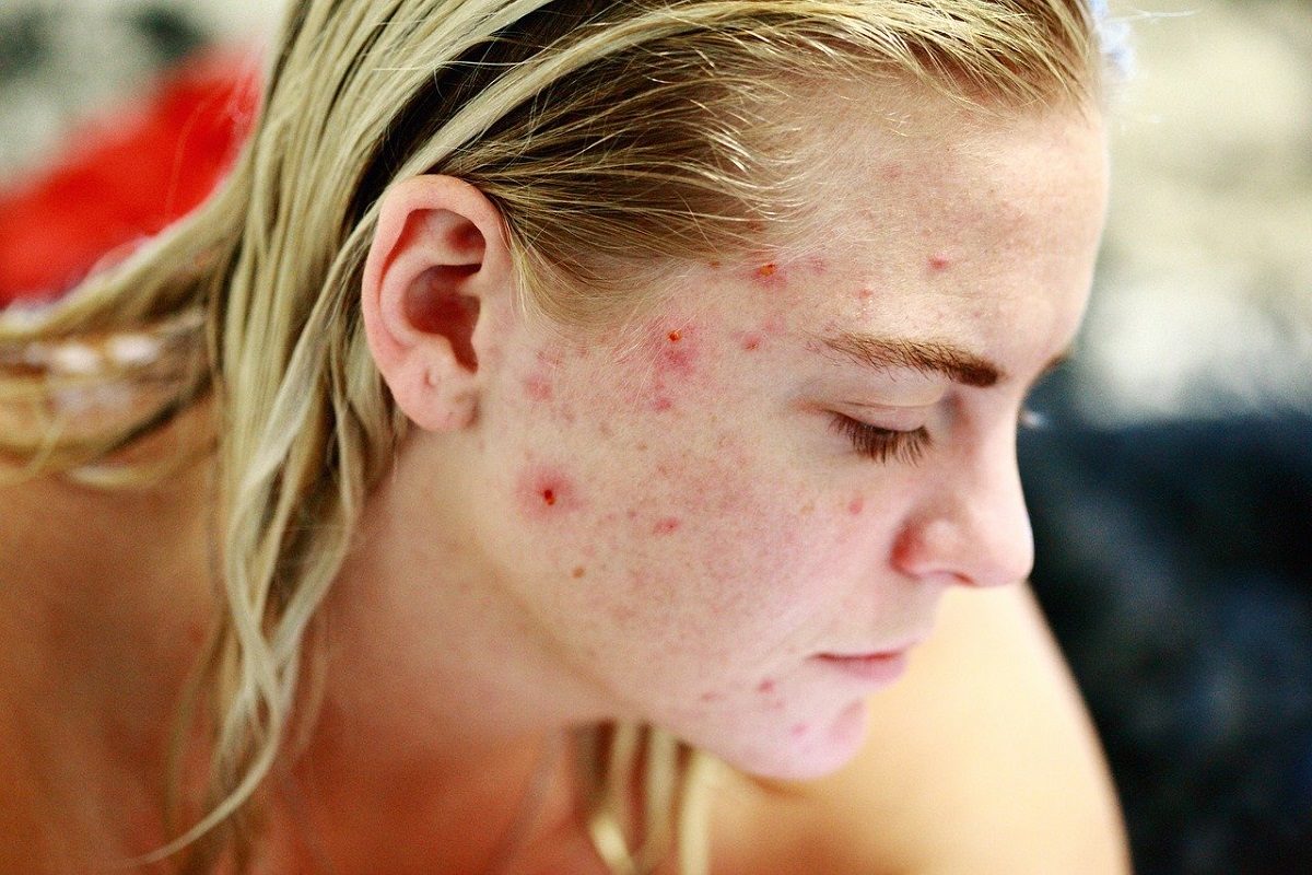 Understanding External And Internal Causes To Better Cure Acne Skin
