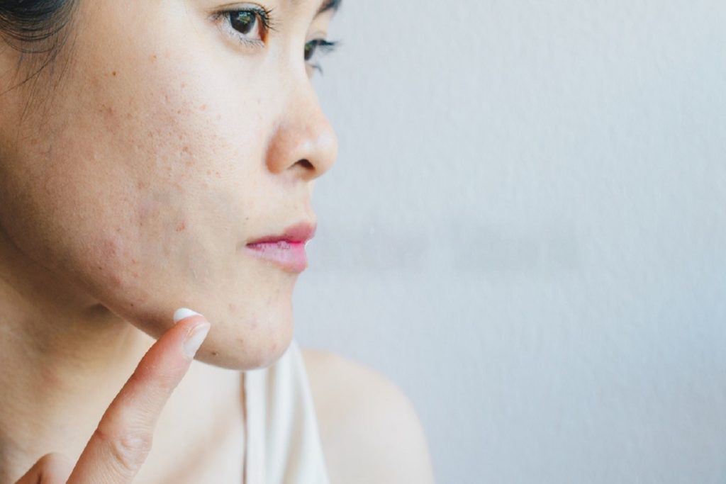 Common Mistakes A Rookie Can Make When Looking At Cures For Acne