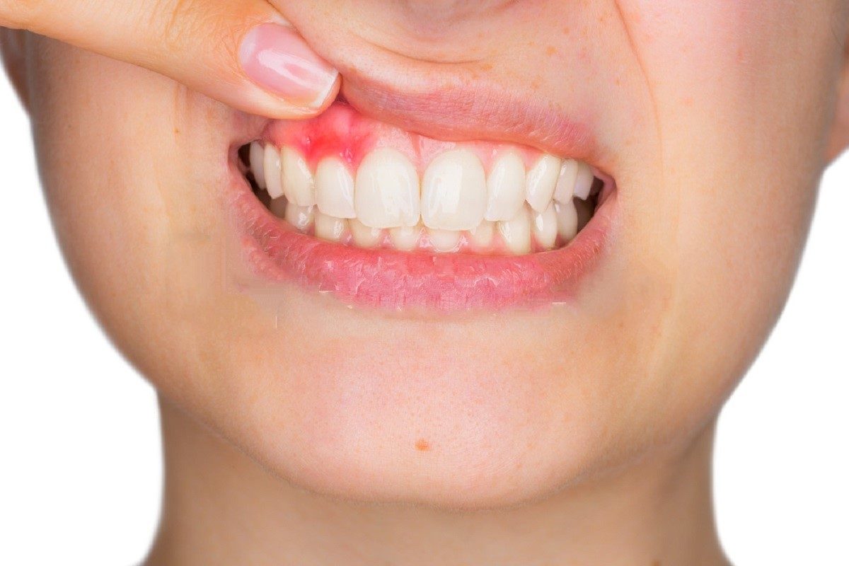 Gum Disease As Bad Breath Cause