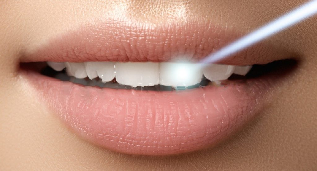 Reasons To Try Laser Teeth Whitening