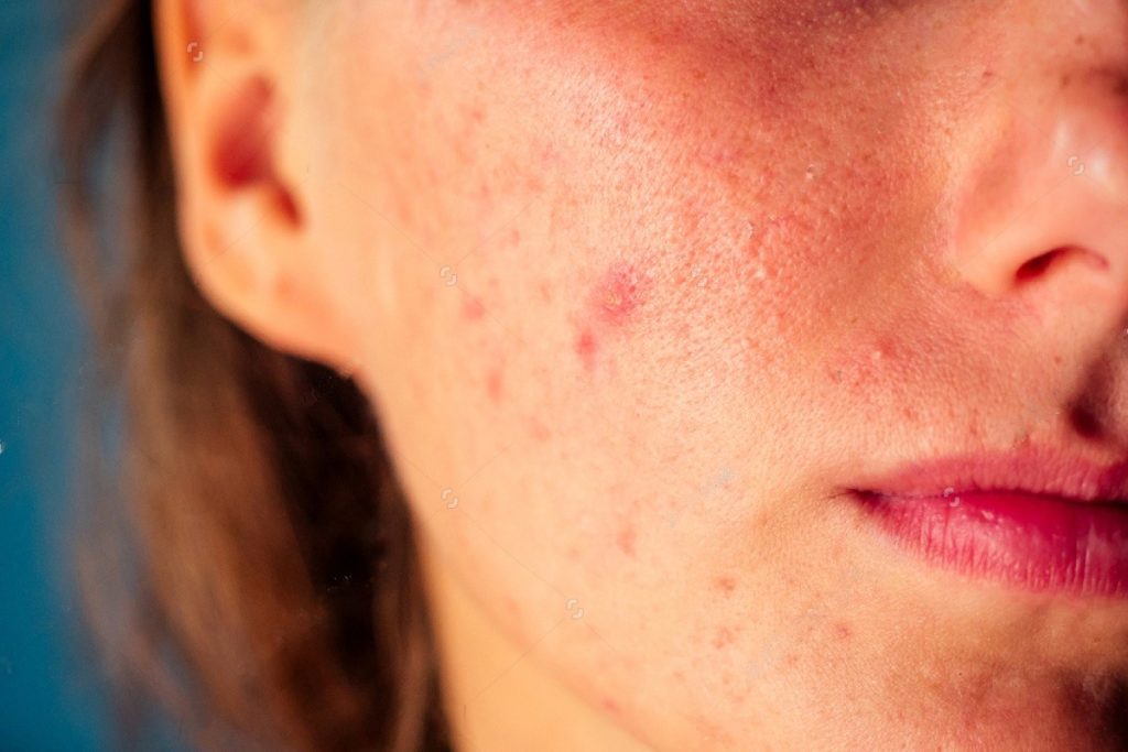 Acne Bacteria And Environment