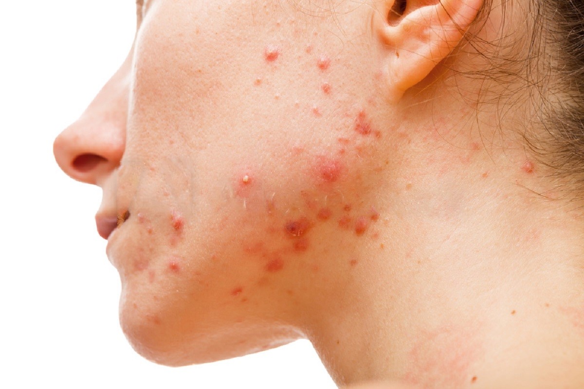 7 Things You Should Never Do To Your Skin Whether You Have Acne Or Not