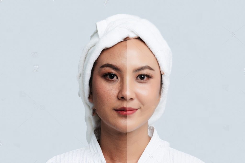 Keep Dark Spots And Hyperpigmentation Away With These Simple Steps