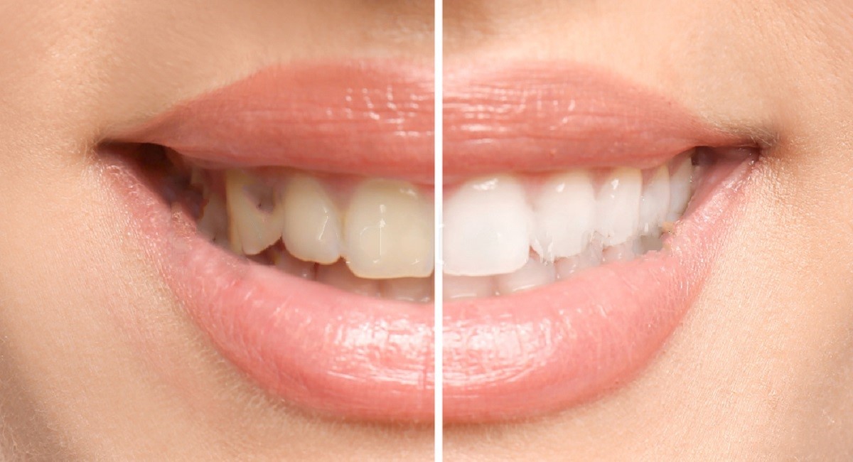 Ancient Teeth Whitening Methods