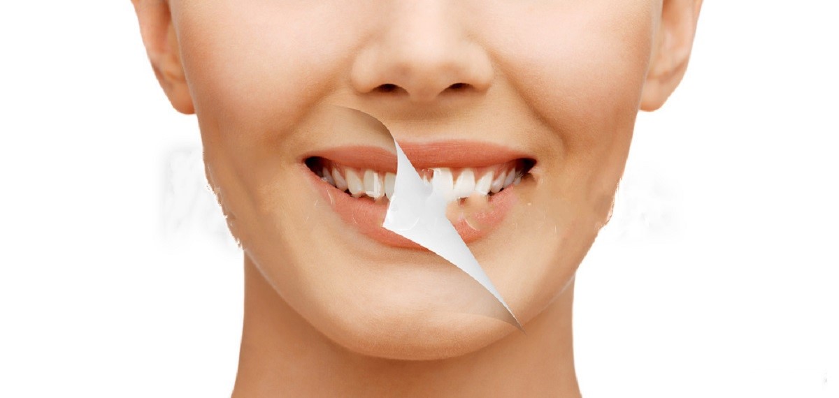 Bleachorexia - A Serious Disorder Which Destroys Your Teeth